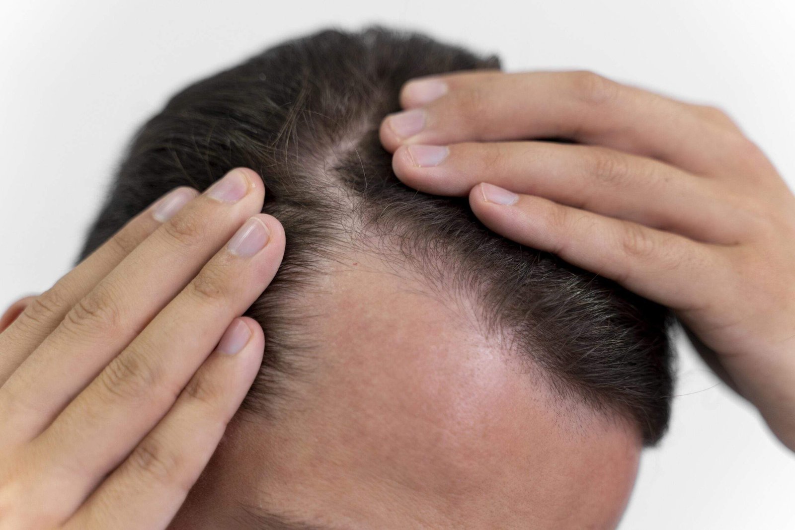What are Alopecia and its causes.